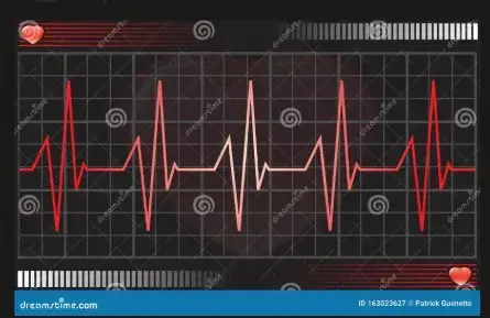 Click to Enlarge

Name: ecg.jpg
Size: 13 KB